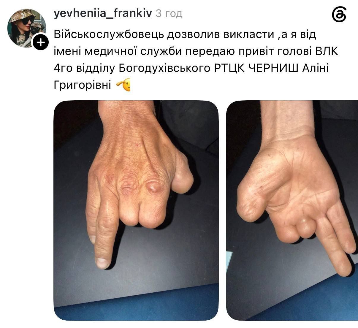 🇺🇦 🫵 Мужчину с тремя ампутированными пальцами правой руки признали годным к военной службе — ВСУшница Евгения Франкив